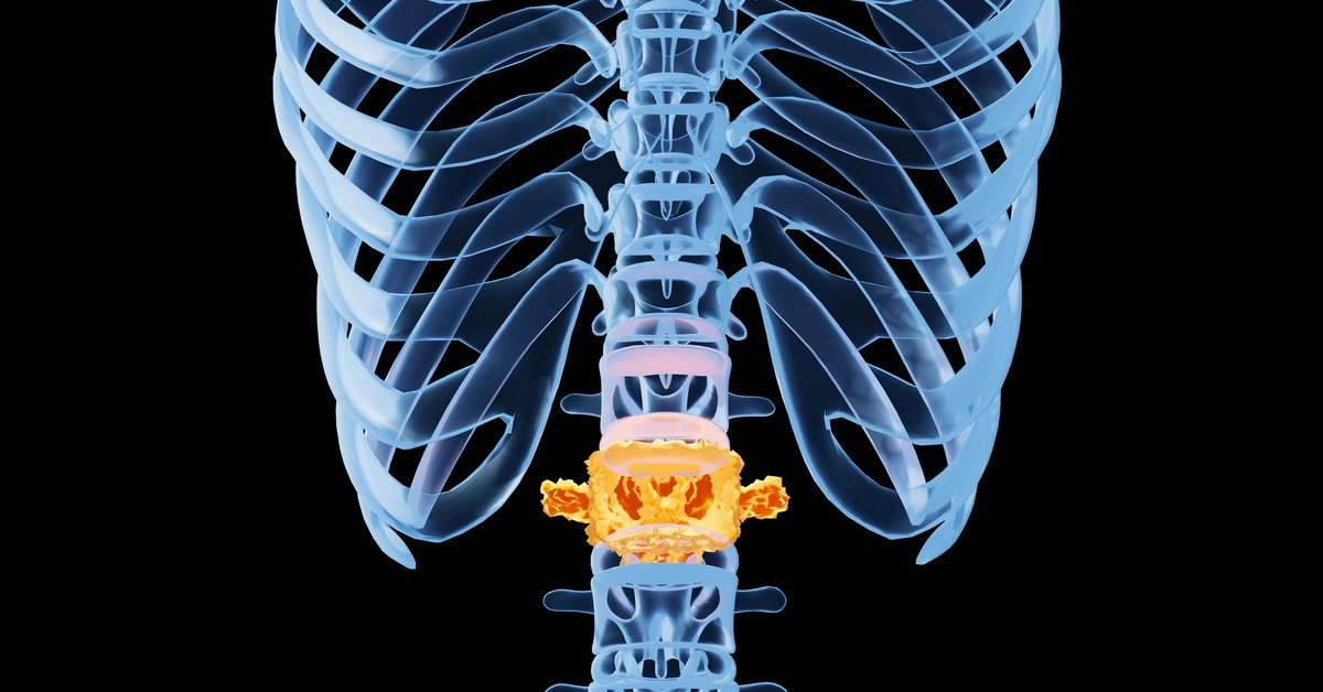 Przekrój kręgosłupa z zaznaczonym na żółto chorym krążkiem międzykręgowym