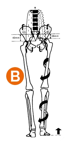 Rysunek przedstawiający zaburzenie statyki miednicy