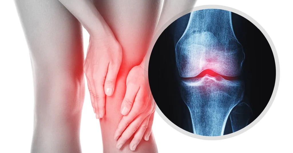 Kobieta trzyma się za bolące kolano. Obok model anatomiczny kolana